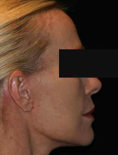 Patient #12663: Facelift & Neck Lift After Image