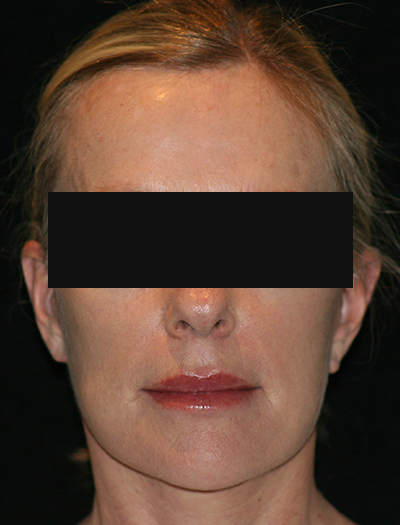 Patient #12663: Facelift & Neck Lift After Image