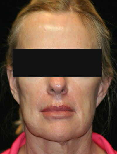 Patient #12663: Facelift & Neck Lift Before Image