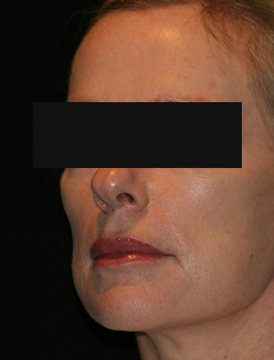 Patient #12663: Facelift & Neck Lift After Image