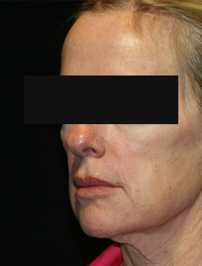 Patient #12663: Facelift & Neck Lift Before Image