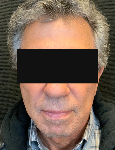 Patient #22800: Facelift & Neck Lift After Image