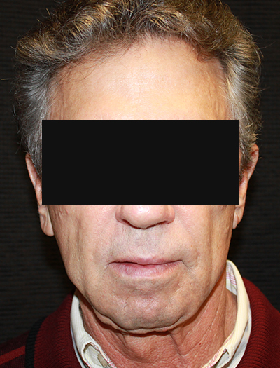 Patient #22800: Facelift & Neck Lift Before Image