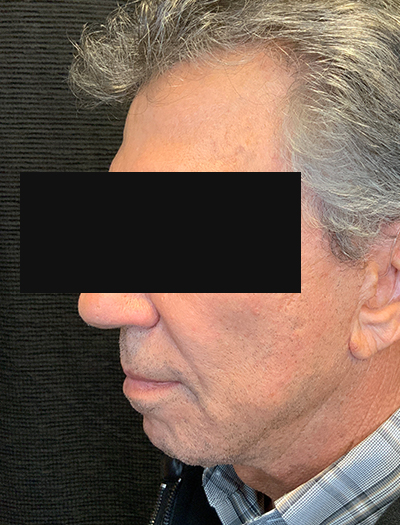 Patient #22800: Facelift & Neck Lift After Image