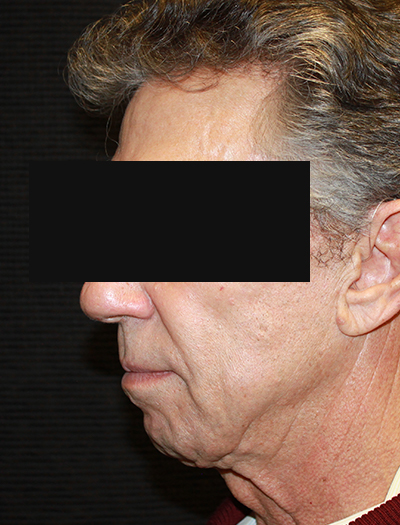 Patient #22800: Facelift & Neck Lift Before Image