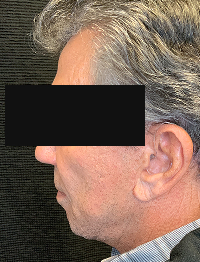 Patient #22800: Facelift & Neck Lift After Image