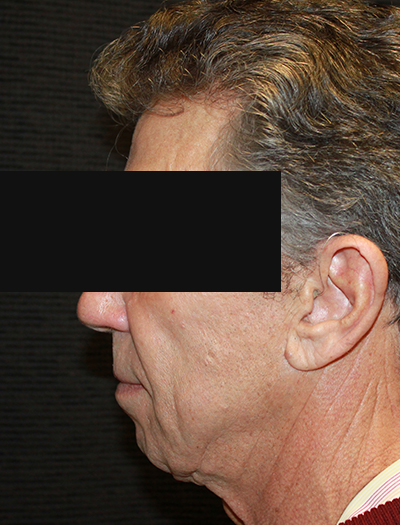 Patient #22800: Facelift & Neck Lift Before Image