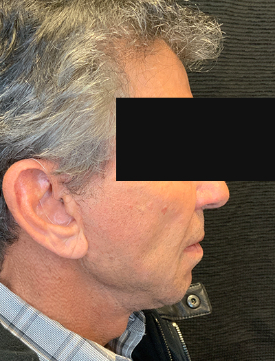 Patient #22800: Facelift & Neck Lift After Image