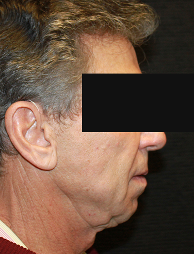 Patient #22800: Facelift & Neck Lift Before Image