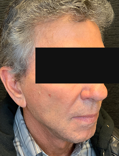Patient #22800: Facelift & Neck Lift After Image