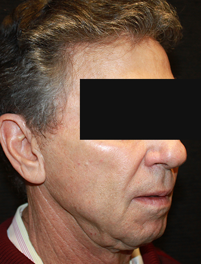 Patient #22800: Facelift & Neck Lift Before Image