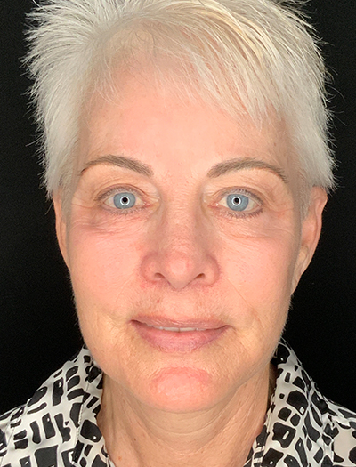 Patient #48183-1: Facelift, Neck Lift, Fat Injections, & Morpheus8 Resurfacing After Image