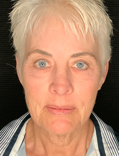 Patient #48183-1: Facelift, Neck Lift, Fat Injections, & Morpheus8 Resurfacing Before Image