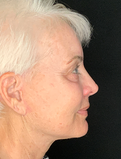 Patient #48183-1: Facelift, Neck Lift, Fat Injections, & Morpheus8 Resurfacing After Image