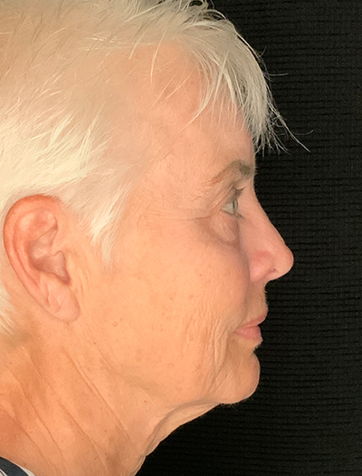 Patient #48183-1: Facelift, Neck Lift, Fat Injections, & Morpheus8 Resurfacing Before Image