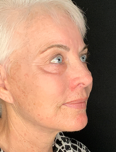 Patient #48183-1: Facelift, Neck Lift, Fat Injections, & Morpheus8 Resurfacing After Image