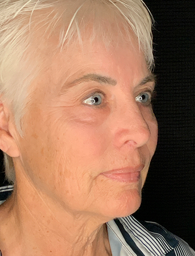 Patient #48183-1: Facelift, Neck Lift, Fat Injections, & Morpheus8 Resurfacing Before Image