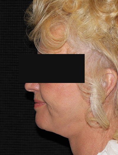 Patient #48437: Facelift & Neck Lift After Image
