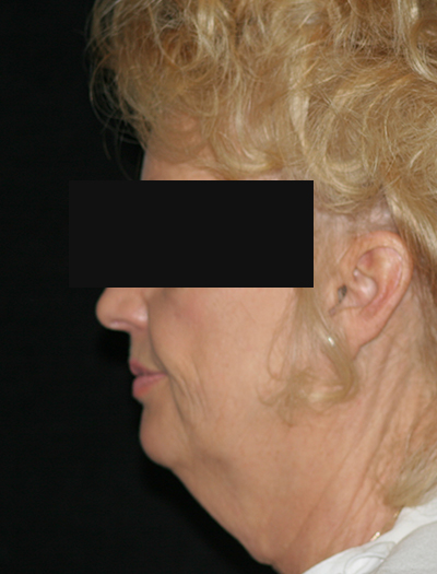 Patient #48437: Facelift & Neck Lift Before Image