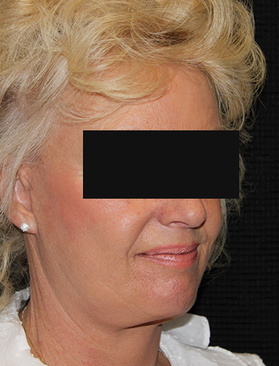 Patient #48437: Facelift & Neck Lift After Image