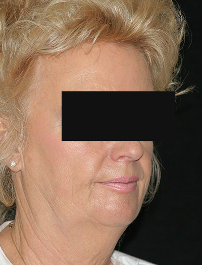 Patient #48437: Facelift & Neck Lift Before Image