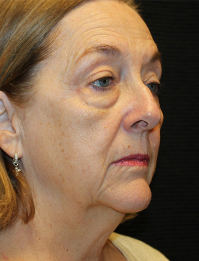 Patient #78573-1: Facelift, Neck Lift, Fat Injections, Upper and Lower Blepharoplasty, & Browlift Before Image