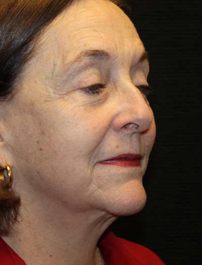 Patient #78573-1: Facelift, Neck Lift, Fat Injections, Upper and Lower Blepharoplasty, & Browlift After Image