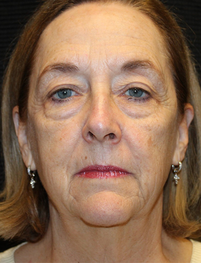Patient #78573-1: Facelift, Neck Lift, Fat Injections, Upper and Lower Blepharoplasty, & Browlift Before Image