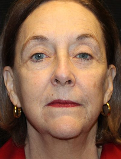 Patient #78573-1: Facelift, Neck Lift, Fat Injections, Upper and Lower Blepharoplasty, & Browlift After Image