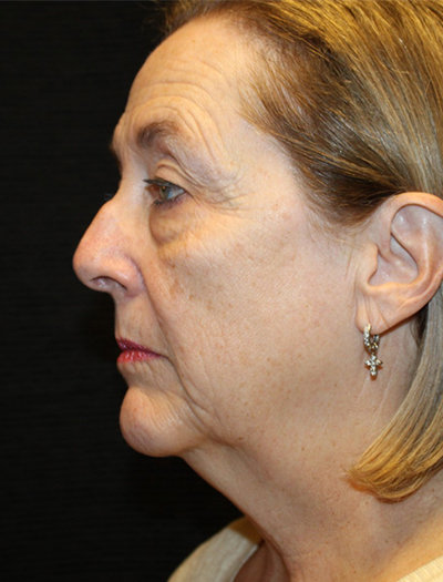 Patient #78573-1: Facelift, Neck Lift, Fat Injections, Upper and Lower Blepharoplasty, & Browlift Before Image