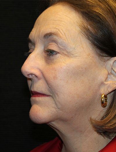 Patient #78573-1: Facelift, Neck Lift, Fat Injections, Upper and Lower Blepharoplasty, & Browlift After Image