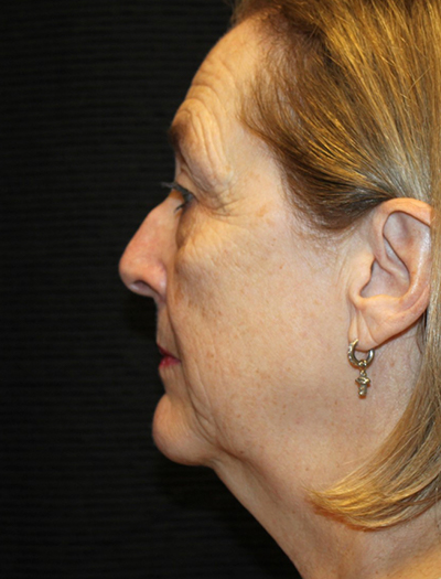 Patient #78573-1: Facelift, Neck Lift, Fat Injections, Upper and Lower Blepharoplasty, & Browlift Before Image