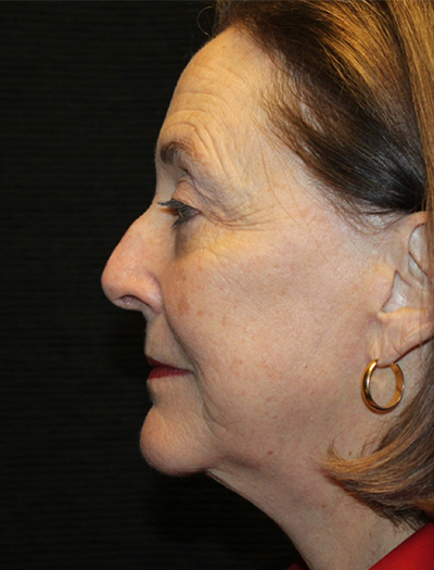 Patient #78573-1: Facelift, Neck Lift, Fat Injections, Upper and Lower Blepharoplasty, & Browlift After Image