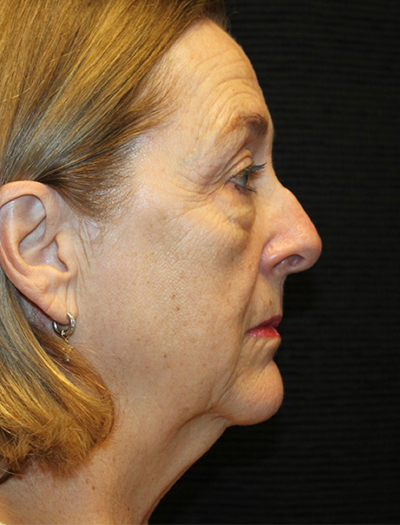 Patient #78573-1: Facelift, Neck Lift, Fat Injections, Upper and Lower Blepharoplasty, & Browlift Before Image