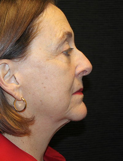 Patient #78573-1: Facelift, Neck Lift, Fat Injections, Upper and Lower Blepharoplasty, & Browlift After Image