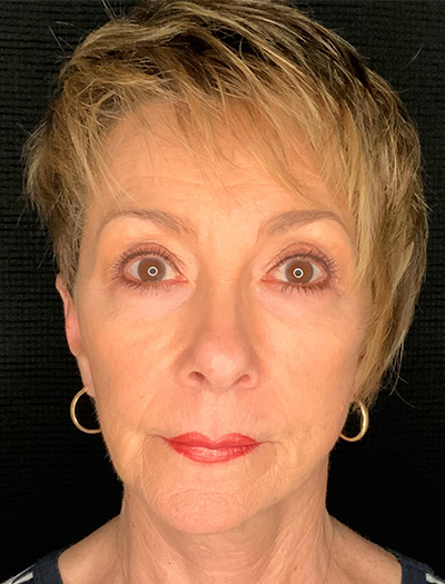 Patient #87861: In-Office Facelift, Facial Fat Transfer, & Upper Blepharoplasty After Image