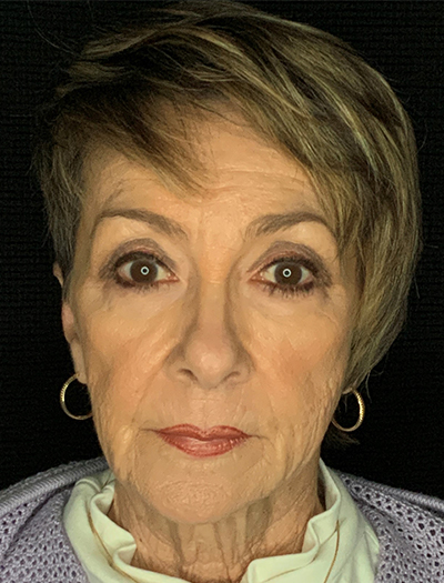Patient #87861: In-Office Facelift, Facial Fat Transfer, & Upper Blepharoplasty Before Image
