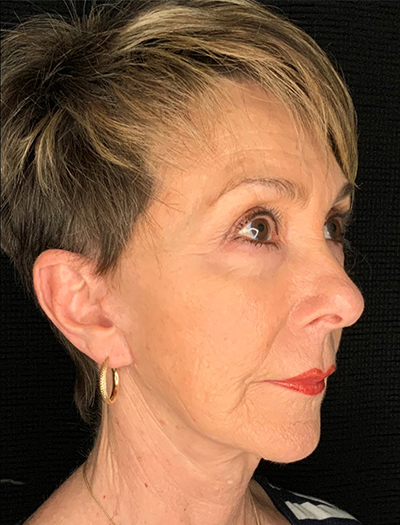 Patient #87861: In-Office Facelift, Facial Fat Transfer, & Upper Blepharoplasty After Image