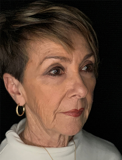 Patient #87861: In-Office Facelift, Facial Fat Transfer, & Upper Blepharoplasty Before Image
