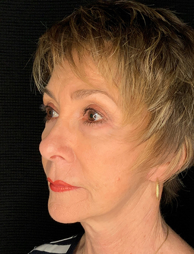 Patient #87861: In-Office Facelift, Facial Fat Transfer, & Upper Blepharoplasty After Image