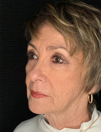 Patient #87861: In-Office Facelift, Facial Fat Transfer, & Upper Blepharoplasty Before Image