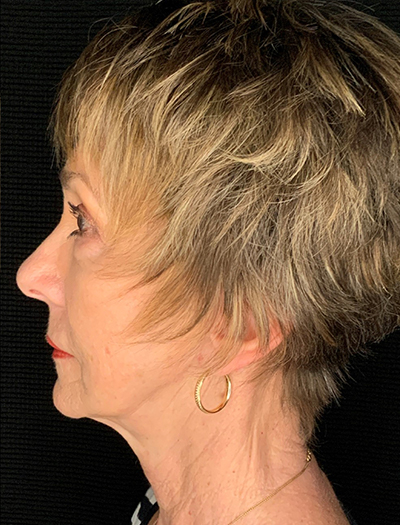 Patient #87861: In-Office Facelift, Facial Fat Transfer, & Upper Blepharoplasty After Image