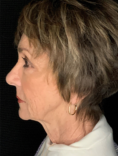 Patient #87861: In-Office Facelift, Facial Fat Transfer, & Upper Blepharoplasty Before Image