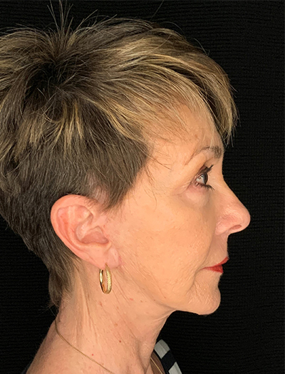 Patient #87861: In-Office Facelift, Facial Fat Transfer, & Upper Blepharoplasty After Image