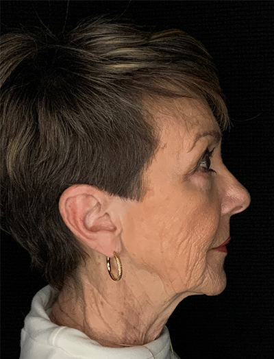 Patient #87861: In-Office Facelift, Facial Fat Transfer, & Upper Blepharoplasty Before Image