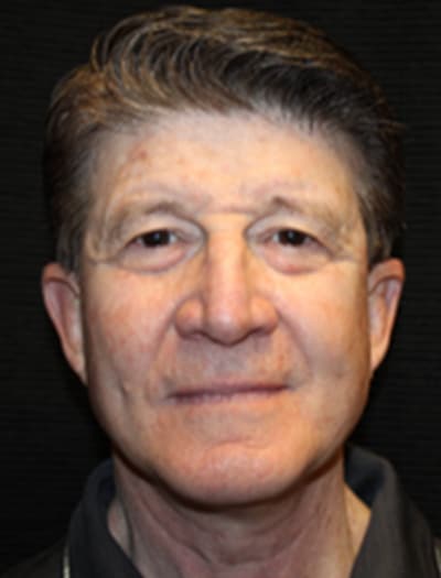 Patient #89278: Facial Fat Transfer After Image