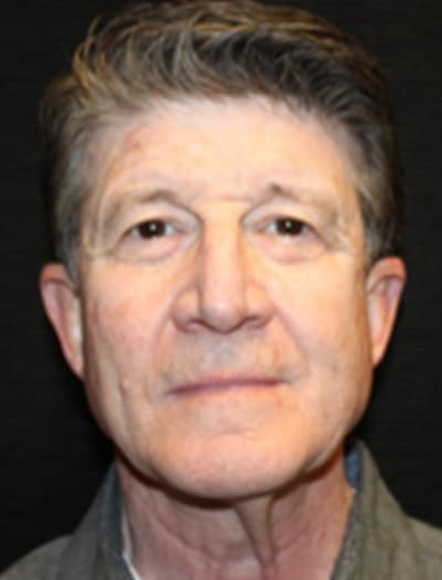 Patient #89278: Facial Fat Transfer Before Image