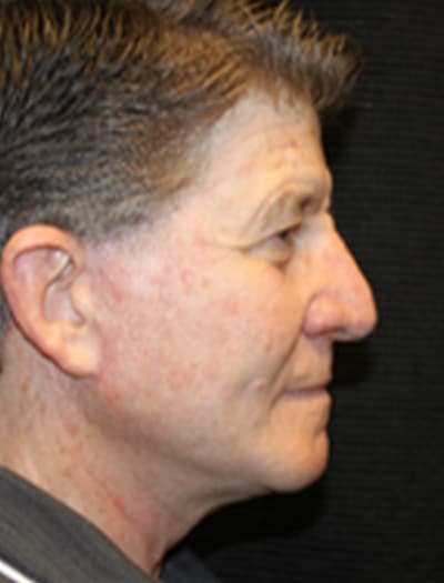 Patient #89278: Facial Fat Transfer After Image
