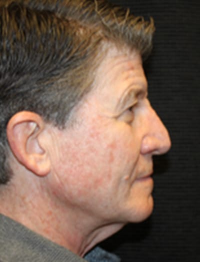 Patient #89278: Facial Fat Transfer Before Image