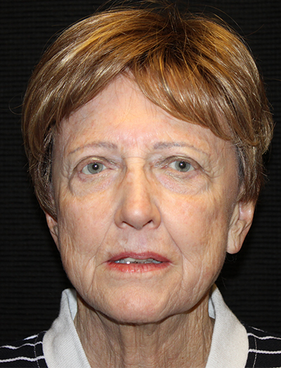 Patient #92784: FaceTite After Image